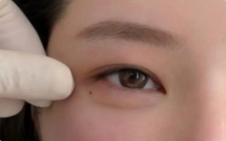 Procedure example of Under-Eye Enhancement (Aegyo-sal)