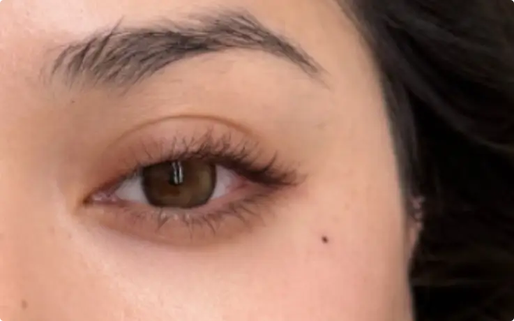 Procedure example of Beauty Mark