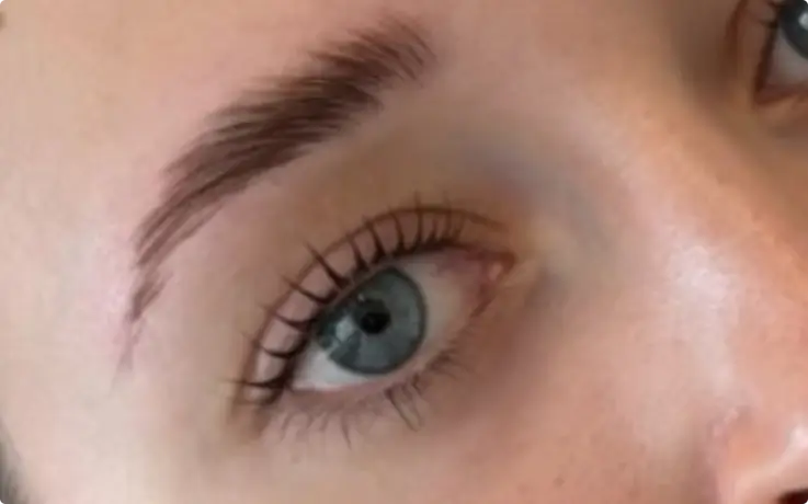 Procedure example of Brow Lift