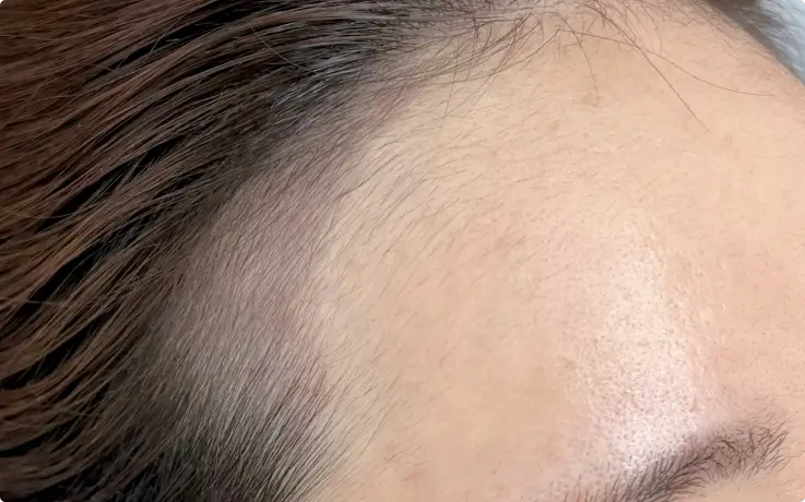 Procedure example of Hairline Tattoo