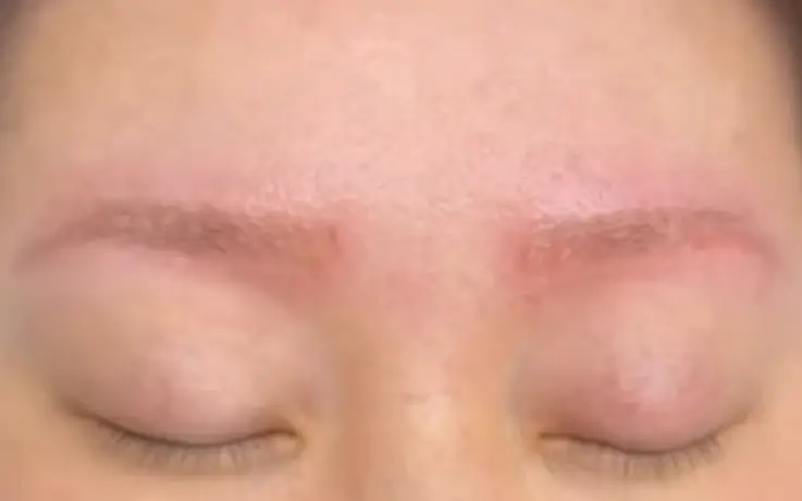 Procedure example of PMU Removal Laser