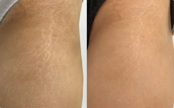 Procedure example of Stretch Mark & Scar Camouflage