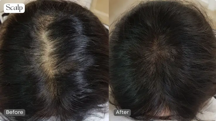 Scalp micropigmentation by ECOJARDIN COEX Samsung Branch.