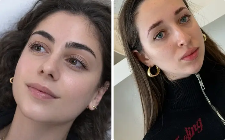 Visitors after the Brow lift procedure