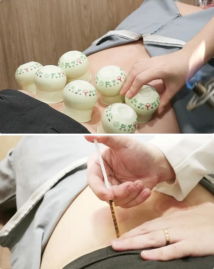 Acupuncture treatment at K-Medicine Clinic in Busan