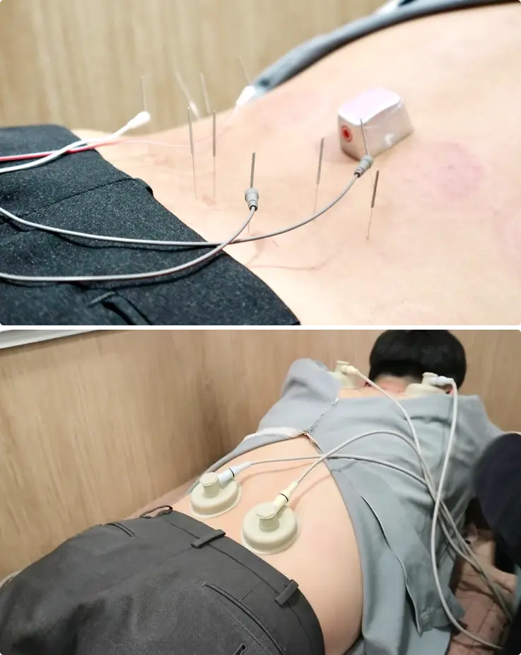 Acupuncture treatment at K-Medicine Clinic in Busan