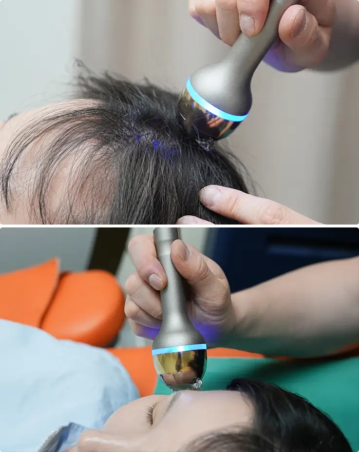 LDM Triple ultrasound device treating both scalp and facial skin areas closely.