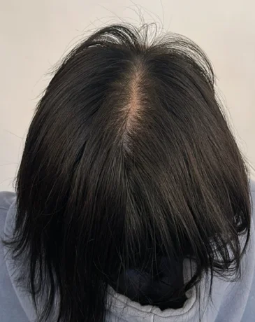 Thin hair part with visible scalp before Humanhandz SMP treatment.