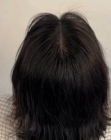 Fuller hair part with natural density after Humanhandz SMP treatment.