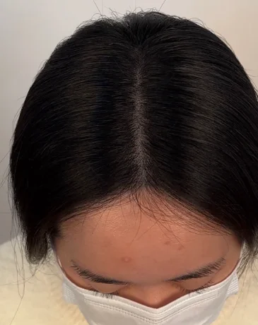 Natural hair part after scalp micropigmentation treatment in Seongsu.
