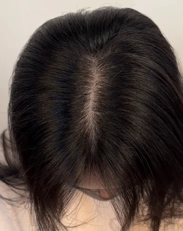 Wide hair part before scalp micropigmentation treatment in Seongsu.