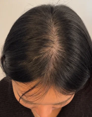Thinning hair part with visible scalp before SMP at Humanhandz.