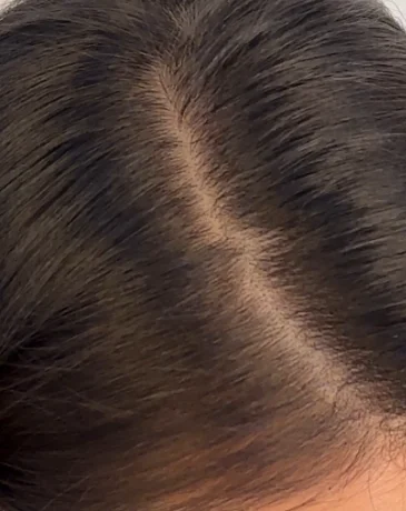 Close-up of a wide hair part with visible scalp before SMP treatment.