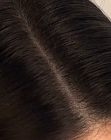 Close-up of a naturally filled hair part with realistic density after SMP.