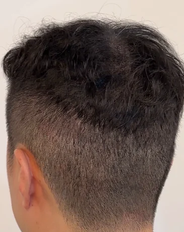 Denser, even crown after scalp micropigmentation treatment at Humanhandz in Seongsu.
