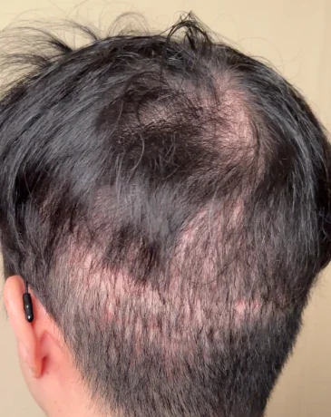 Patchy crown with visible scalp before scalp micropigmentation treatment in Seongsu.