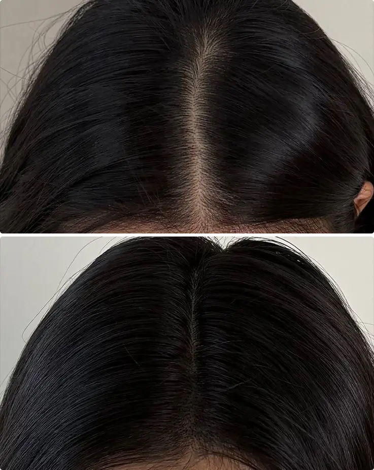 Before-and-after scalp micropigmentation result showing sparse parting transformed into natural density.