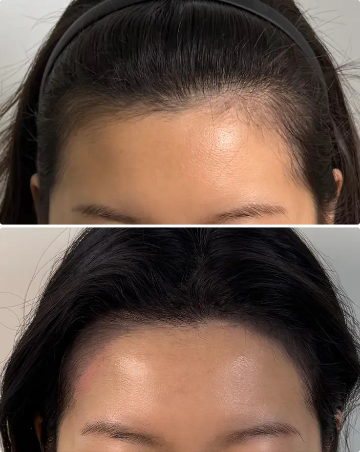 Before-and-after hairline contouring SMP restoring a receded hairline naturally.