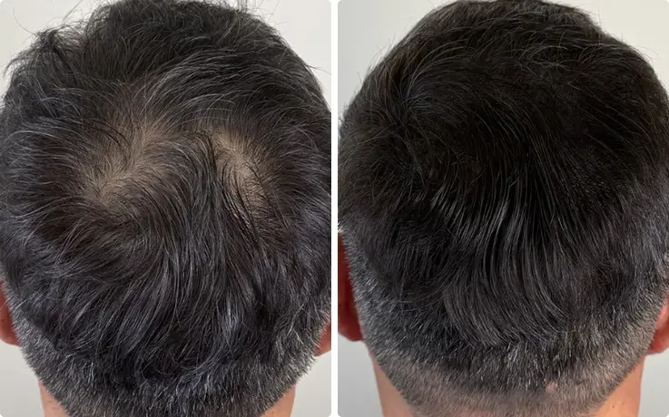 Before-and-after crown SMP transforming thinning area into full, natural density.