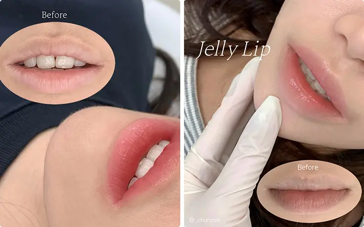 Jelly lip semi-permanent tattoo application shown transforming natural lips before treatment begins.