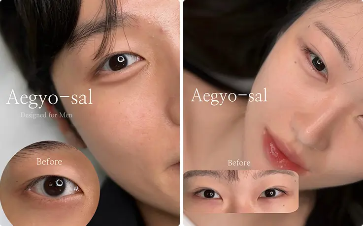 Natural aegyo-sal shading transformation shown before and after for men and women.