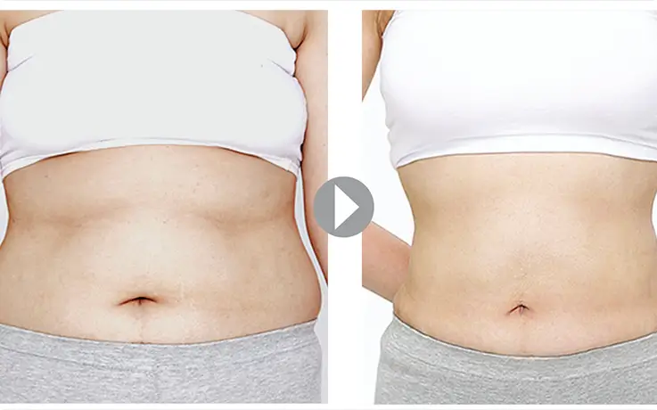 Before and after body liposuction abdominal contouring results at DA Clinic.