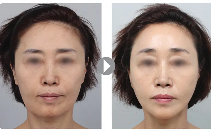 Before and after facelift surgery results showing remarkable skin tightening at DA Clinic.