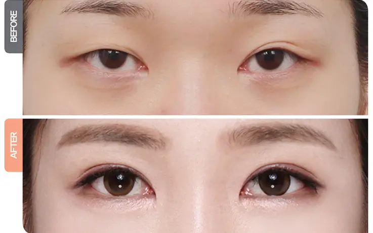 Before and after double eyelid surgery results at DA Clinic.