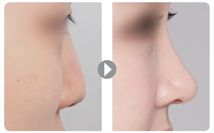 Before and after rhinoplasty nose reshaping transformation at DA Clinic.