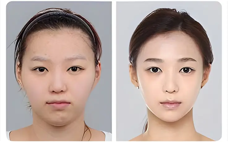 Dramatic full facial contouring before and after results at DA Clinic.