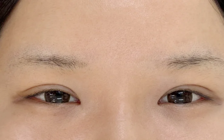 Sparse, faint eyebrows before hair stroke semi-permanent makeup at Humanhandz in Seongsu.