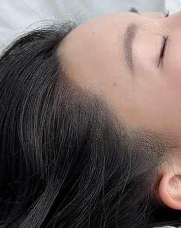Side profile of a softer, natural-looking hairline after SMP at Humanhandz Seongsu.