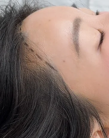 Side profile of an uneven, sparse hairline before SMP at Humanhandz Seongsu.