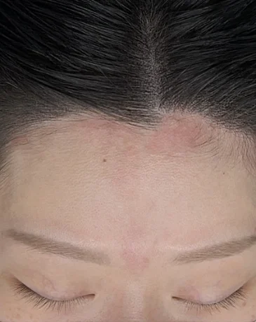 Balanced hairline after SMP at Humanhandz in Seoul.