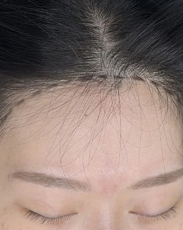 Sparse hairline with visible scalp before SMP in Seoul.