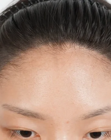 Natural hairline matched to face shape after Humanhandz SMP treatment in Seoul.
