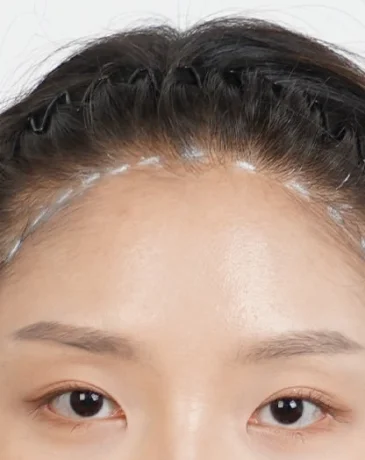 Sparse hairline marked for custom design before Humanhandz SMP treatment in Seongsu.