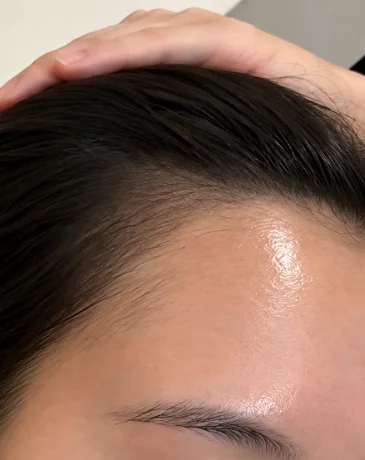 Close-up of a natural SMP hairline with fuller, defined edges after treatment.