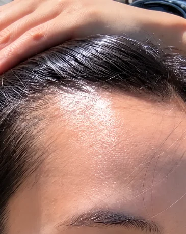 Close-up of a sparse hairline before SMP treatment in natural sunlight.