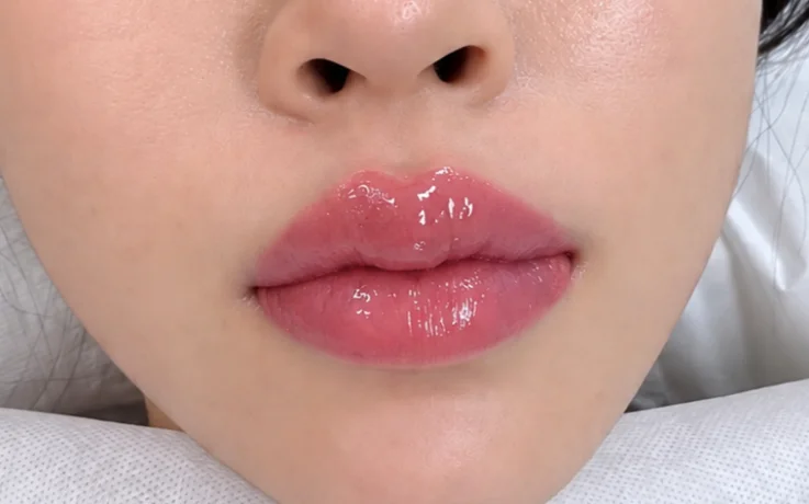 Glossy pink lips after Korean lip blush PMU with smooth, even color.