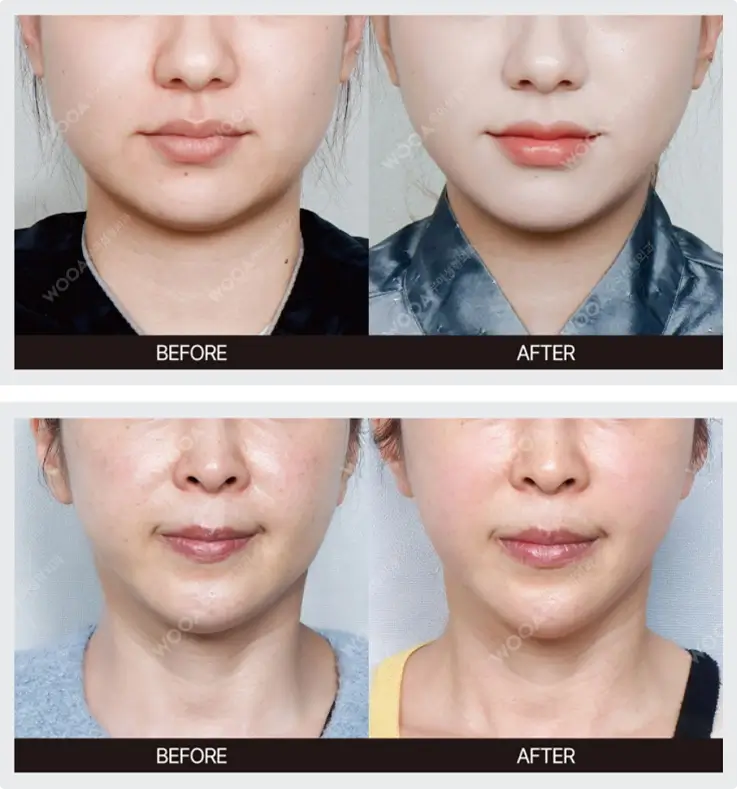 Before and after of lifting laser at Wooa Skin Clinic in Gangnam