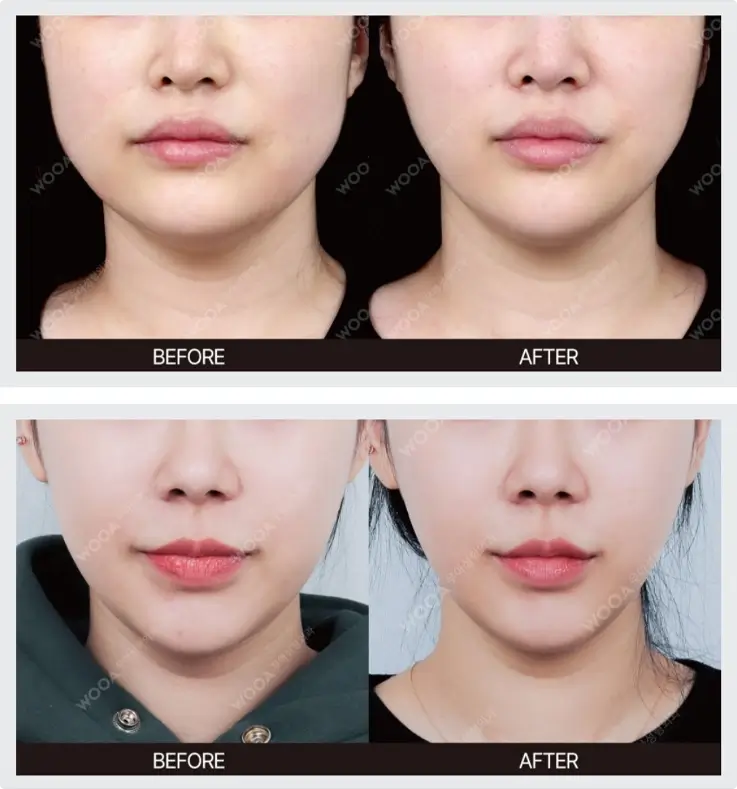 Before and after of lifting laser at Wooa Skin Clinic in Gangnam