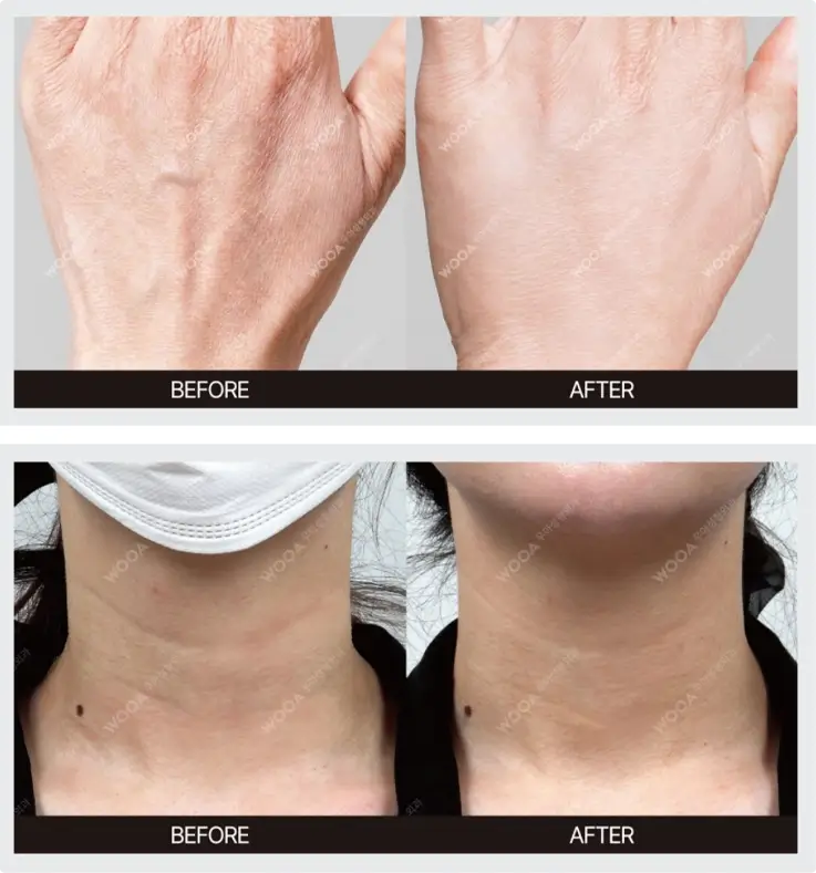 Before and after of skin booster at Wooa Skin Clinic in Gangnam