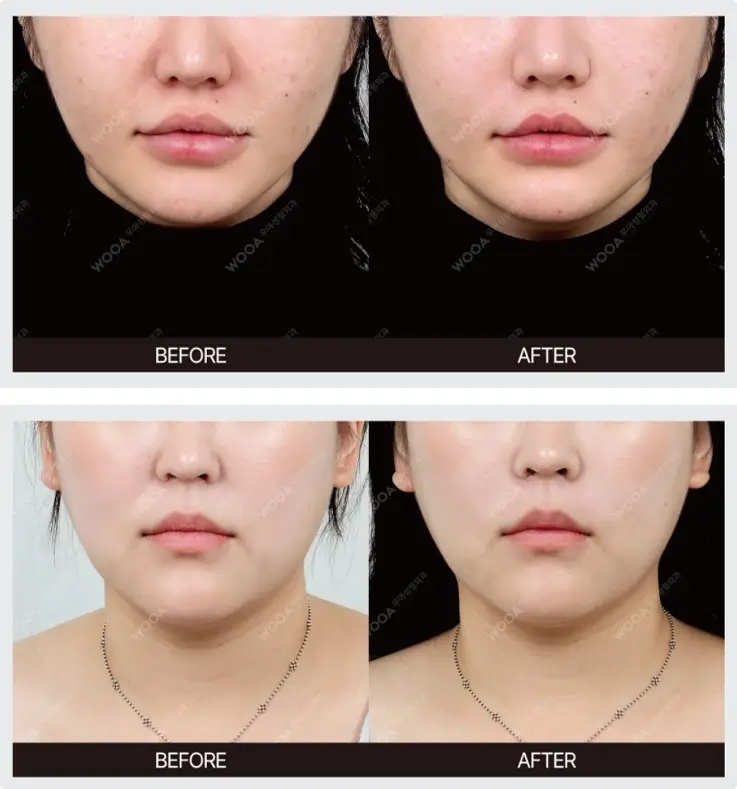 Before and after of skin booster at Wooa Skin Clinic in Gangnam