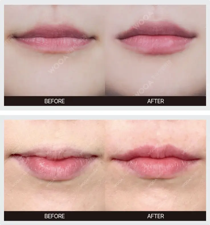 Before and after of lip filler at Wooa Skin Clinic in Gangnam