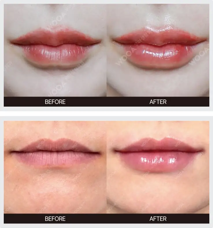 Before and after of lip filler at Wooa Skin Clinic in Gangnam